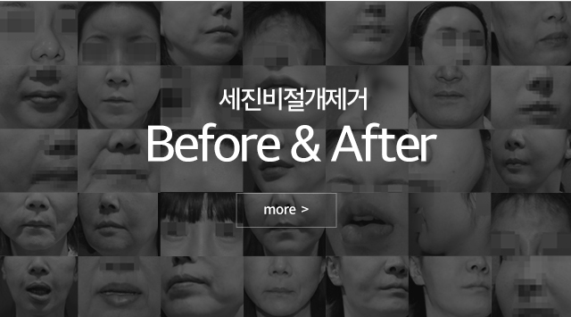  필러제거