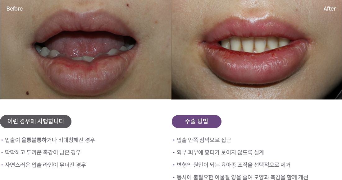입술 육아종 절제술 예