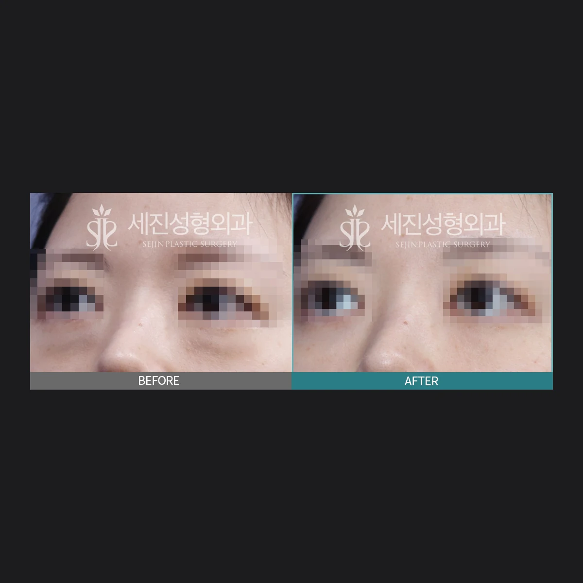 눈밑 이물질 제거 전후 사례
