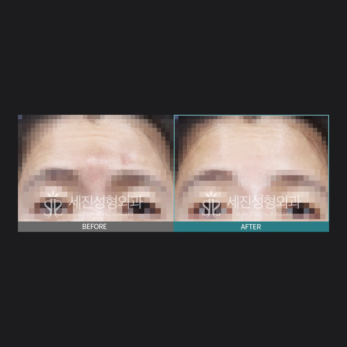이마와 미간 이물질 제거 전후 사례