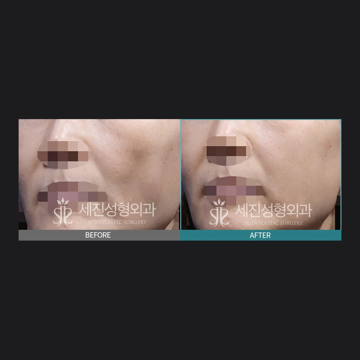 앞볼 이물질 제거 전후 사례