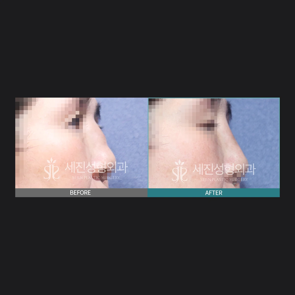 코 이물질 제거 전후 사례